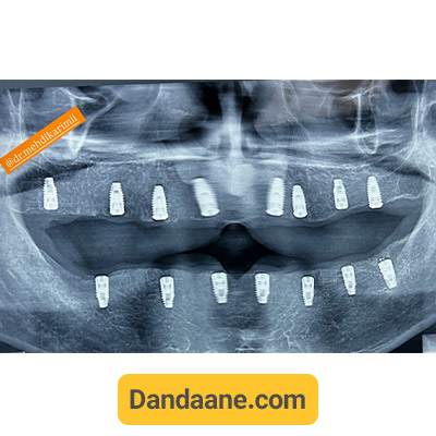 عکس او پی جی نمونه کار بعد کاشت ایمپلنت دندان توسط دکتر مهدی کریمی