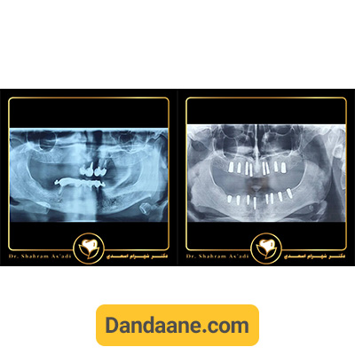 عکس او پی جی نمونه کار قبل و بعد ایمپلنت دندان دکتر شهرام اسعدی - شماره  4