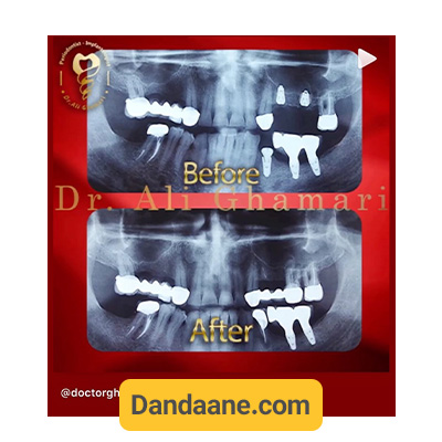 عکس opg از نمونه کار قبل و بعد ایمپلنت دندان توسط دکتر علی قمری