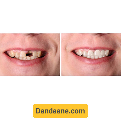 نمونه کار ایمپلنت دندان جلو دکتر علی قمری