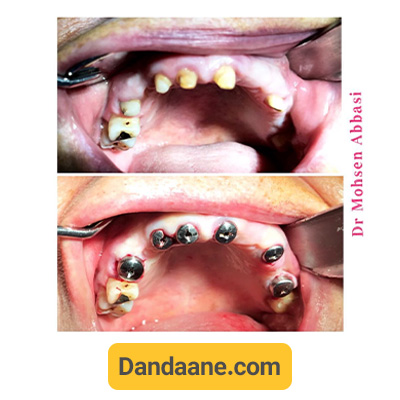 نمونه کار ایمپلنت دندان دکتر محسن عباسی شماره 2