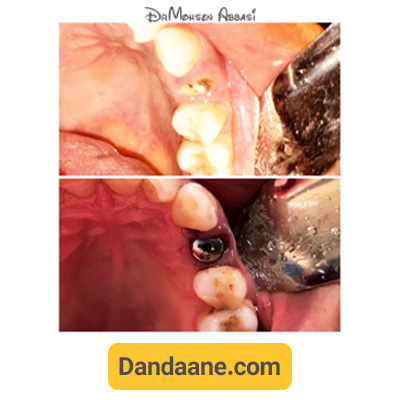 نمونه کار ایمپلنت دکتر محسن عباسی - شماره 1