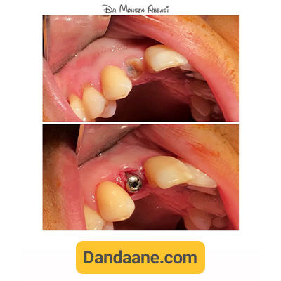 نمونه کار ایمپلنت دکتر محسن عباسی - شماره 3