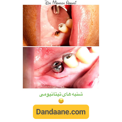 نمونه کار ایمپلنت دکتر محسن عباسی - شماره 4