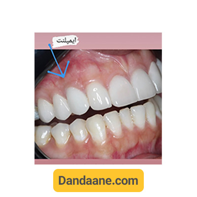 نمونه کار بعد ایمپلنت دندان دکتر آرش غفوری - شماره 1