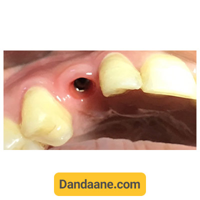 نمونه کار بعد کاشت ایمپلنت دندان توسط دکتر جعفر معماریان شماره 1