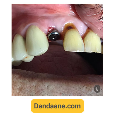 نمونه کار بعد کاشت ایمپلنت دندان توسط دکتر جعفر معماریان