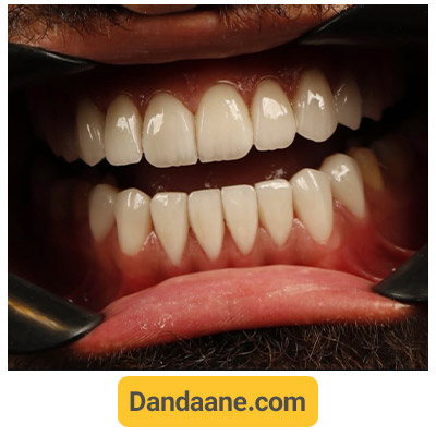 نمونه کار بعد کاشت ایمپلنت دندان توسط دکتر مهدی کریمی - شماره 1