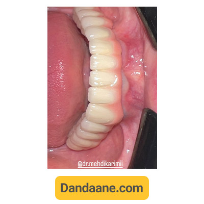 نمونه کار بعد کاشت ایمپلنت دندان توسط دکتر مهدی کریمی - شماره 2