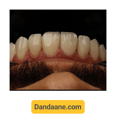 نمونه کار بعد کاشت ایمپلنت دندان توسط دکتر مهدی کریمی شماره 3