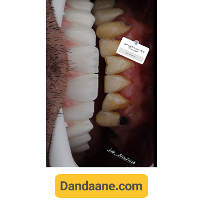 نمونه کار بعد کاشت ایمپلنت دندان توسط دکتر مهدی کریمی