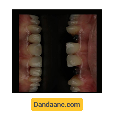نمونه کار تحویل 2 واحد روکش ایمپلنت دندان توسط دکتر آرش غفوری