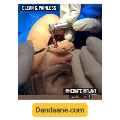 نمونه کار جراحی ایمپلنت فوری توسط دکتر آرش غفوری