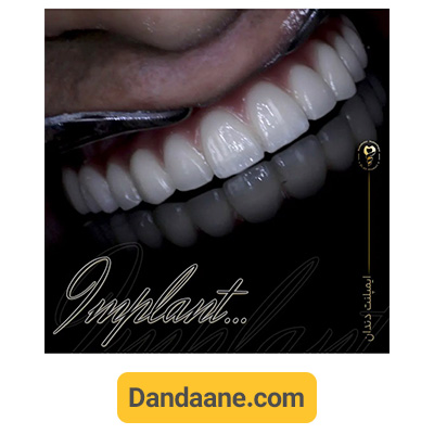 نمونه کار فول ایمپلنت فک بالا دکتر علی قمری