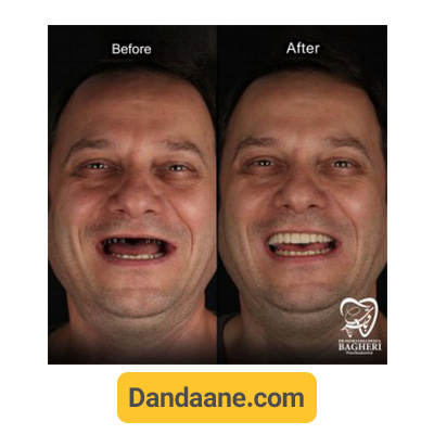 نمونه کار قبل و بعد ایمپلنت دندان توسط دکتر محمدرضا باقری شماره 3