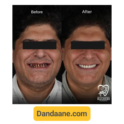 نمونه کار قبل و بعد ایمپلنت دندان توسط دکتر محمدرضا باقری شماره 4