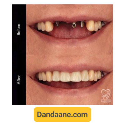 نمونه کار قبل و بعد ایمپلنت دندان توسط دکتر محمدرضا باقری شماره 5