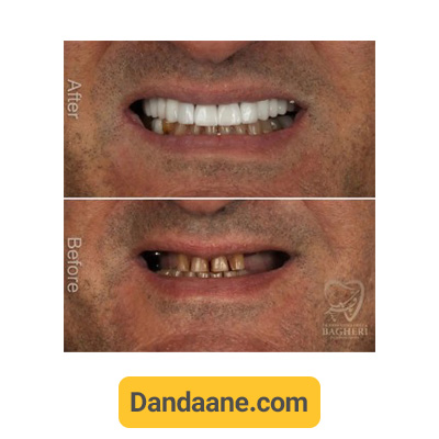 نمونه کار قبل و بعد ایمپلنت دندان توسط دکتر محمدرضا باقری شماره 6
