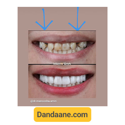 نمونه کار قبل و بعد ایمپلنت دندان دکتر آرش غفوری - شماره 2