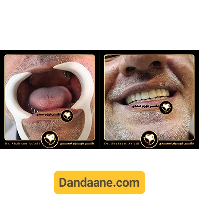 نمونه کار قبل و بعد ایمپلنت دندان دکتر شهرام اسعدی - شماره 6