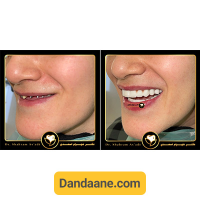 نمونه کار قبل و بعد ایمپلنت دندان دکتر شهرام اسعدی - شماره 2