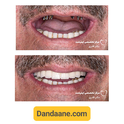 نمونه کار قبل و بعد ایمپلنت دندان دکتر مرتضی قادری - شماره 1