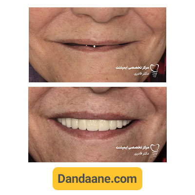 نمونه کار قبل و بعد ایمپلنت دندان دکتر مرتضی قادری - شماره 2