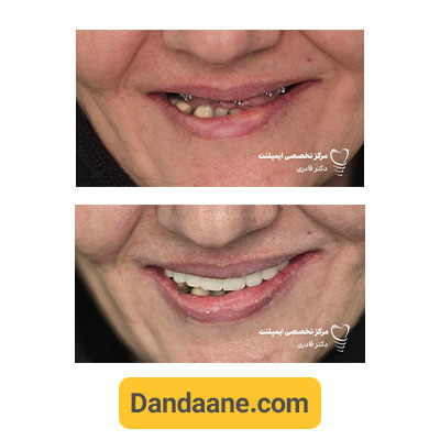 نمونه کار قبل و بعد ایمپلنت دندان دکتر مرتضی قادری - شماره 3