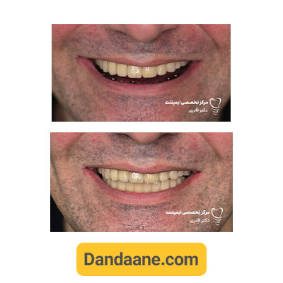 نمونه کار قبل و بعد ایمپلنت دندان دکتر مرتضی قادری - شماره 4