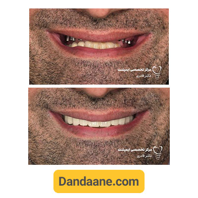 نمونه کار قبل و بعد ایمپلنت دندان دکتر مرتضی قادری - شماره 6
