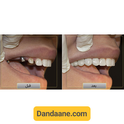 نمونه کار قبل و بعد ایمپلنت دندان دکتر وحید دهقان - شماره 1