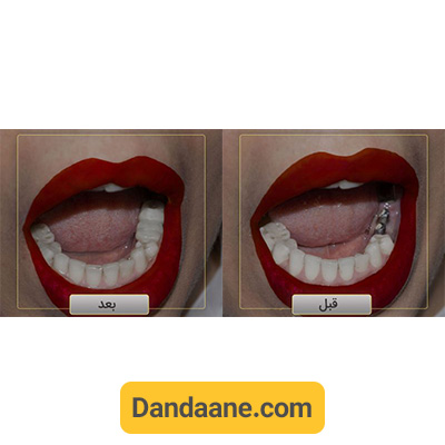 نمونه کار قبل و بعد ایمپلنت دندان دکتر وحید دهقان - شماره 3
