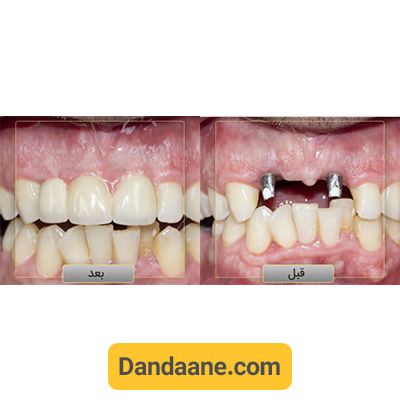 نمونه کار قبل و بعد ایمپلنت دندان دکتر وحید دهقان - شماره 4