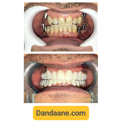 نمونه کار قبل و بعد ایمپلنت دندان کلینیک دندانپزشکی دکتر آریام شماره 1