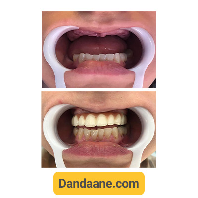 نمونه کار قبل و بعد ایمپلنت دندان کلینیک دندانپزشکی دکتر آریام شماره 2