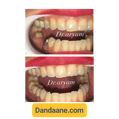 نمونه کار قبل و بعد ایمپلنت دندان کلینیک دندانپزشکی دکتر آریام شماره 3