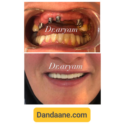 نمونه کار قبل و بعد ایمپلنت دندان کلینیک دندانپزشکی دکتر آریام شماره 4