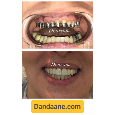 نمونه کار قبل و بعد ایمپلنت دندان کلینیک دندانپزشکی دکتر آریام شماره 5