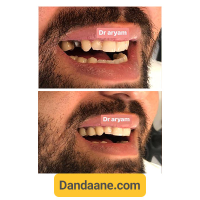 نمونه کار قبل و بعد ایمپلنت دندان کلینیک دندانپزشکی دکتر آریام شماره 6