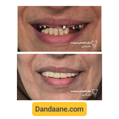 نمونه کار قبل و بعد ایمپلنت دندان دکتر مرتضی قادری - شماره 5