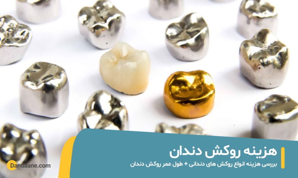 هزینه روکش دندان