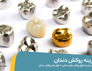 هزینه روکش دندان