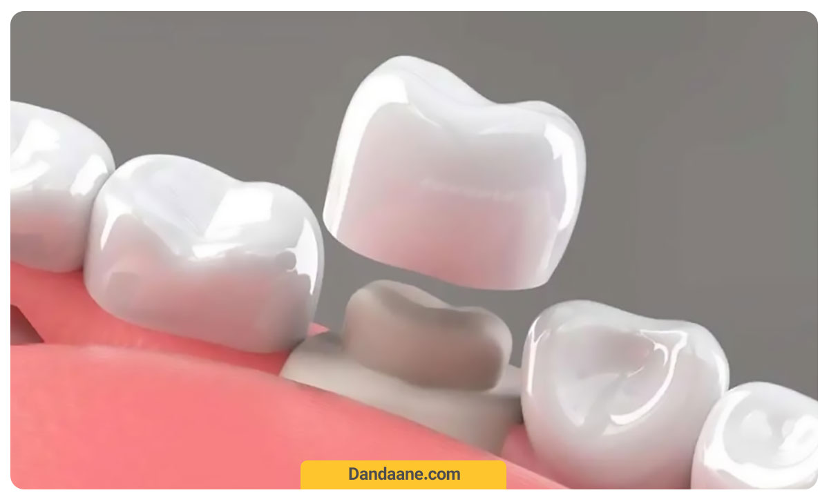 کاهش هزینه های روکش دندان