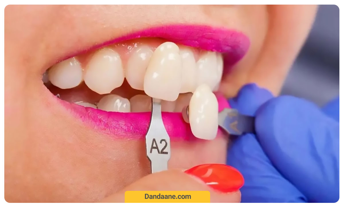 روکش دندان لمینت حین نصب