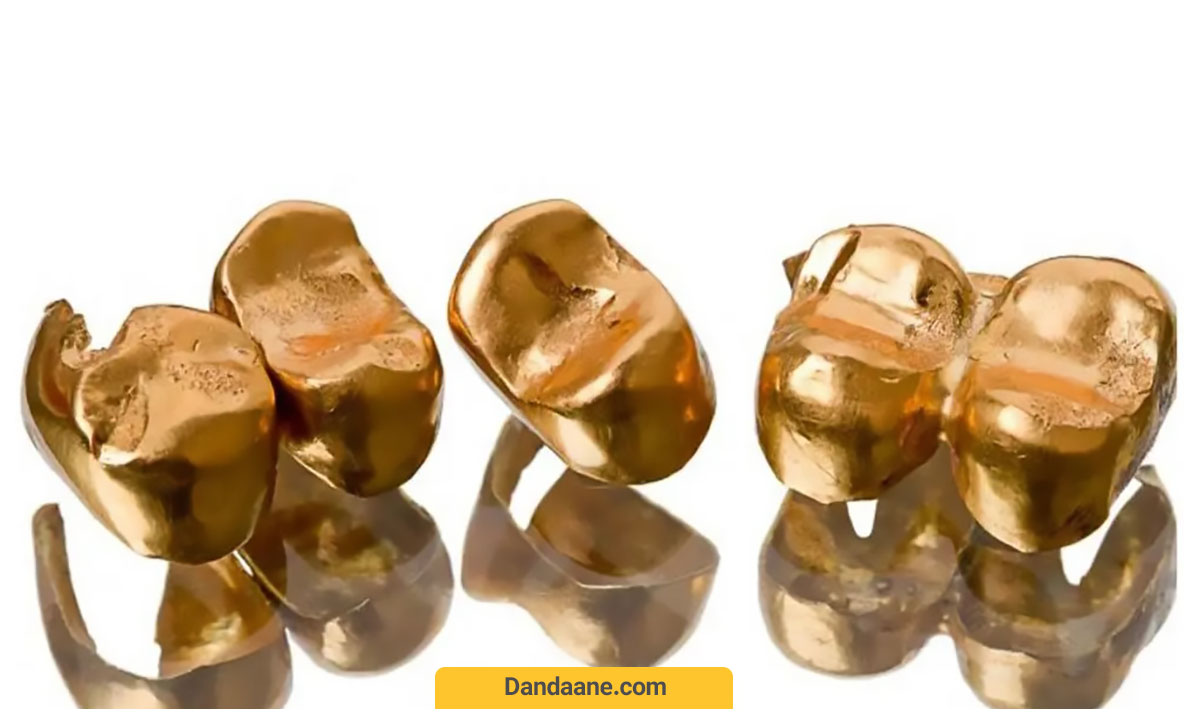 عکس روکش دندان طلا