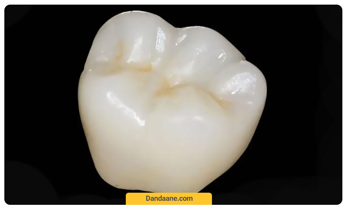 عکس روکش دندان زیرکونیا همراه با هزینه