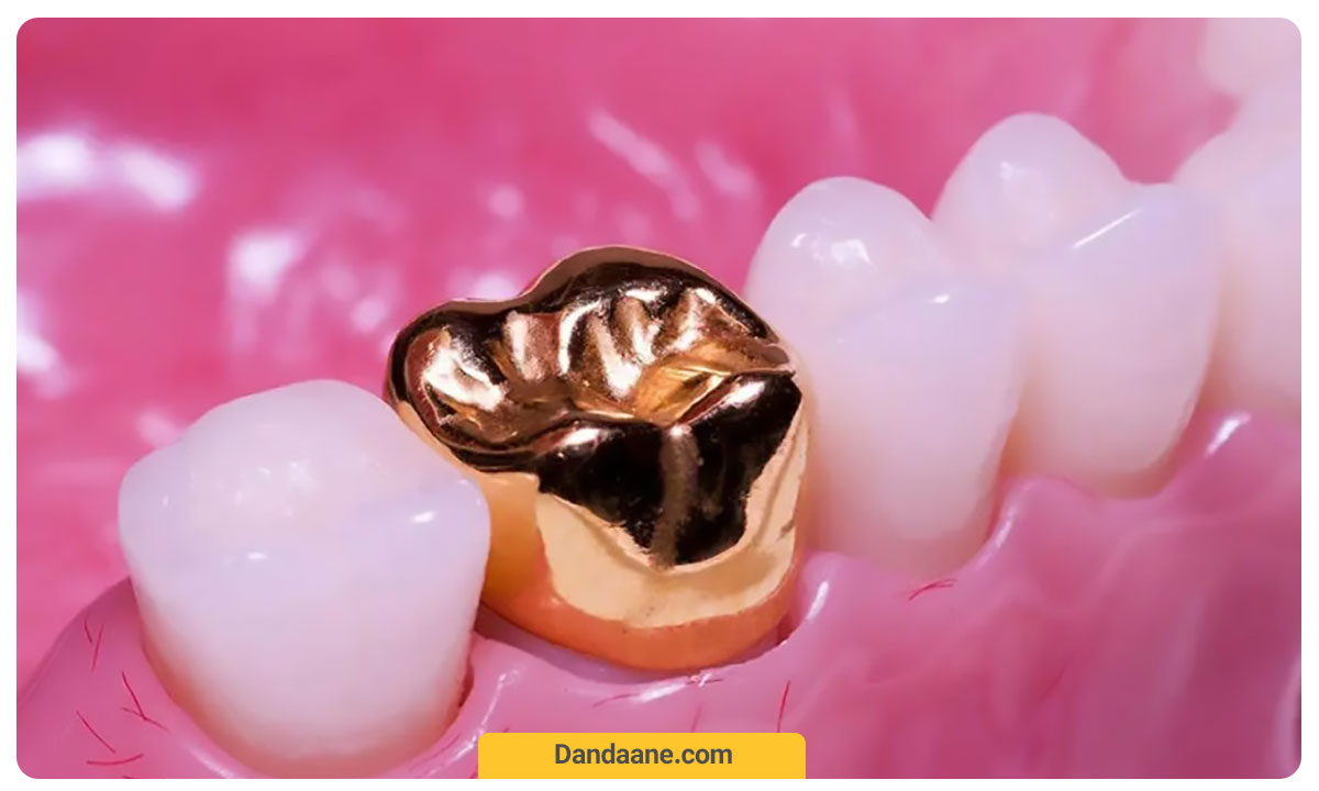 روکش دندان فلزی