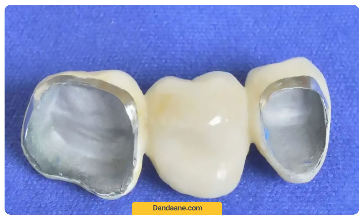 عکس دو روکش دندان فلز سرامیک در ساختمان بریج دندان.