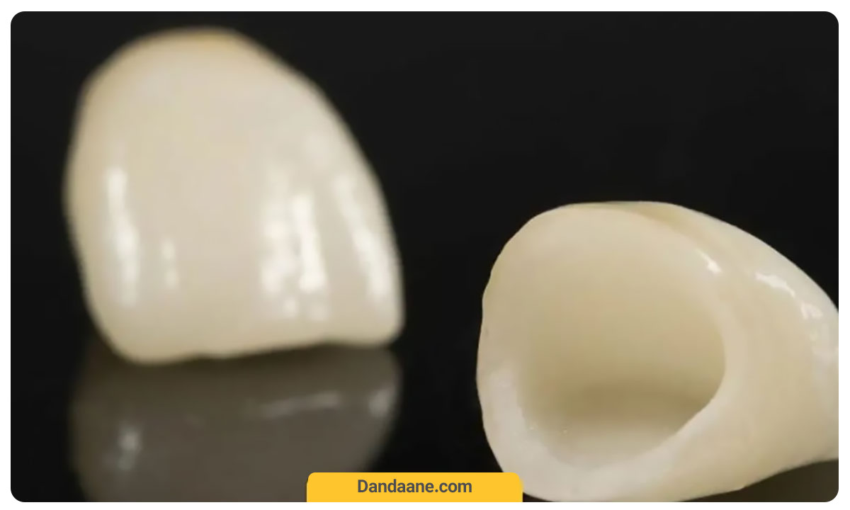 عکس روکش دندان سرامیکی که تماما از سرامیک ساخته شده است