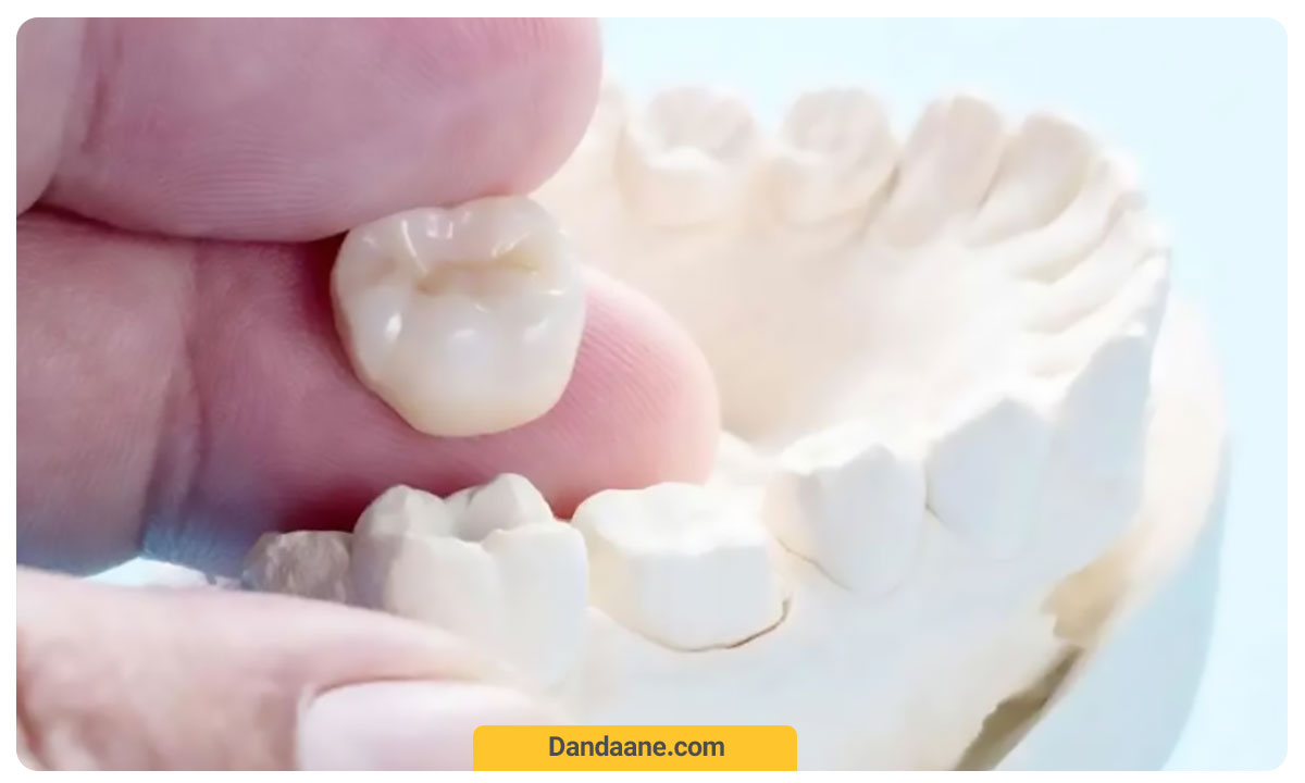 چسباندن مجدد روکش دندان